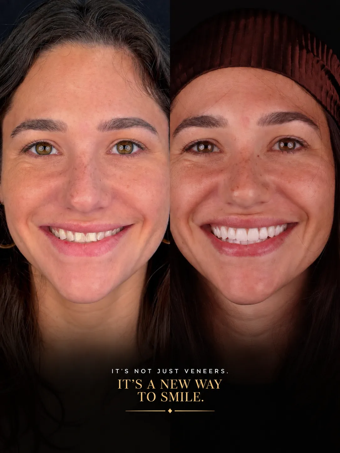 Female patient before and after porcelain veneers, natural smile transformation